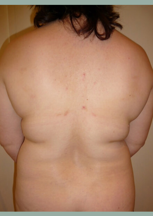 Lipo-corps035-1
