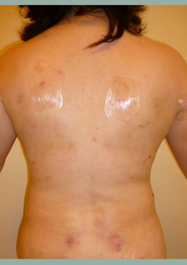 Lipo-corps035-2