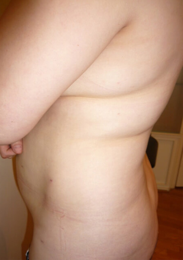 Lipo-corps036-1