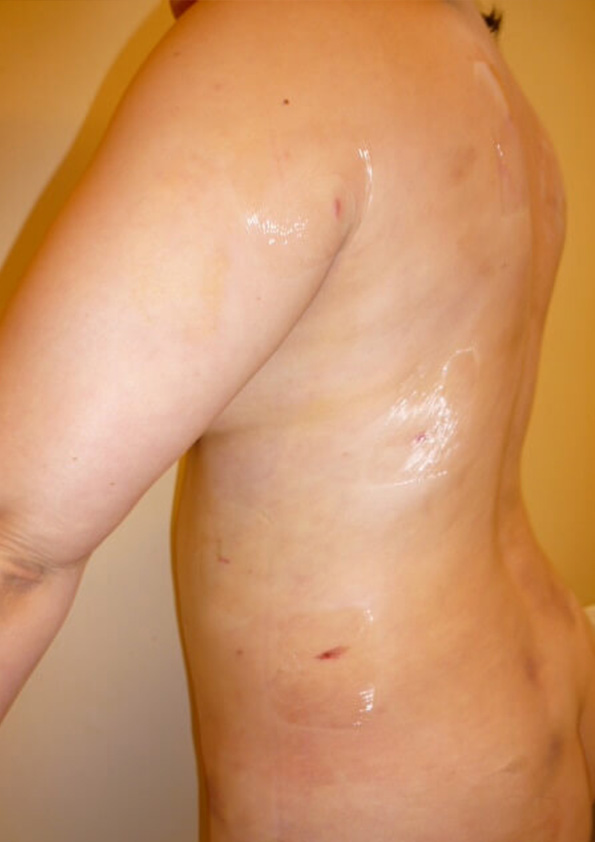 Lipo-corps036-2