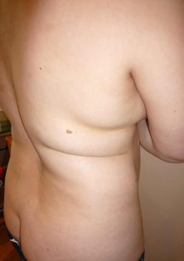 Lipo-corps037-1