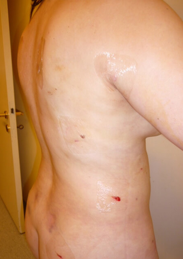 Lipo-corps037-2