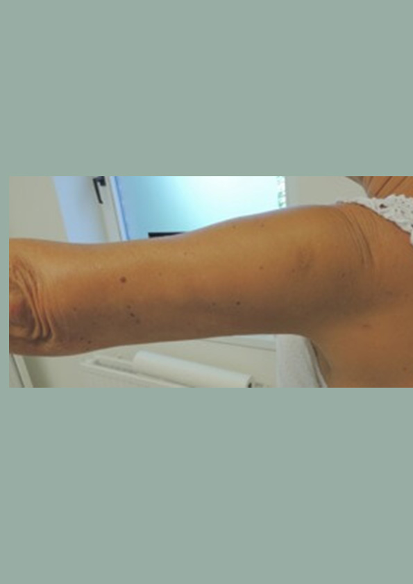 Lipo-corps040-2